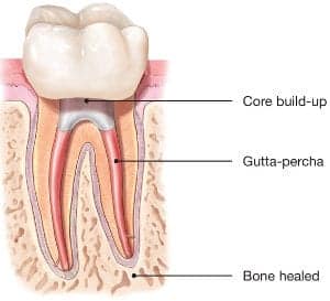 Root Canal Treatment
