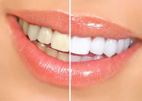 Teeth Whitening in Lucknow