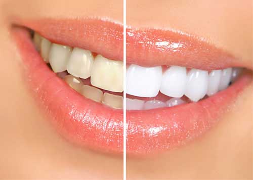 Teeth Whitening in Lucknow