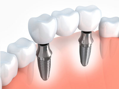 Dental Implant in Lucknow